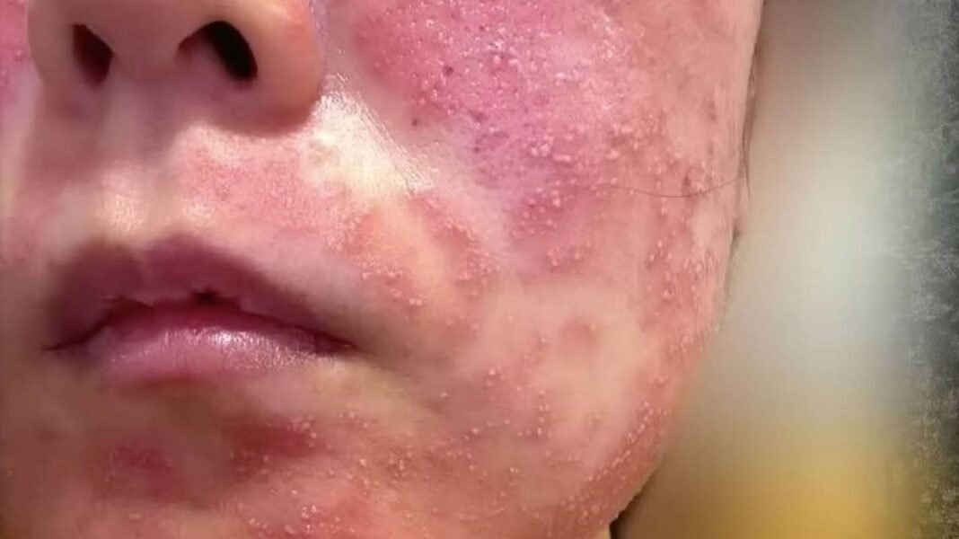“Bride’s Beauty Nightmare: Microneedle Treatment Goes Wrong”