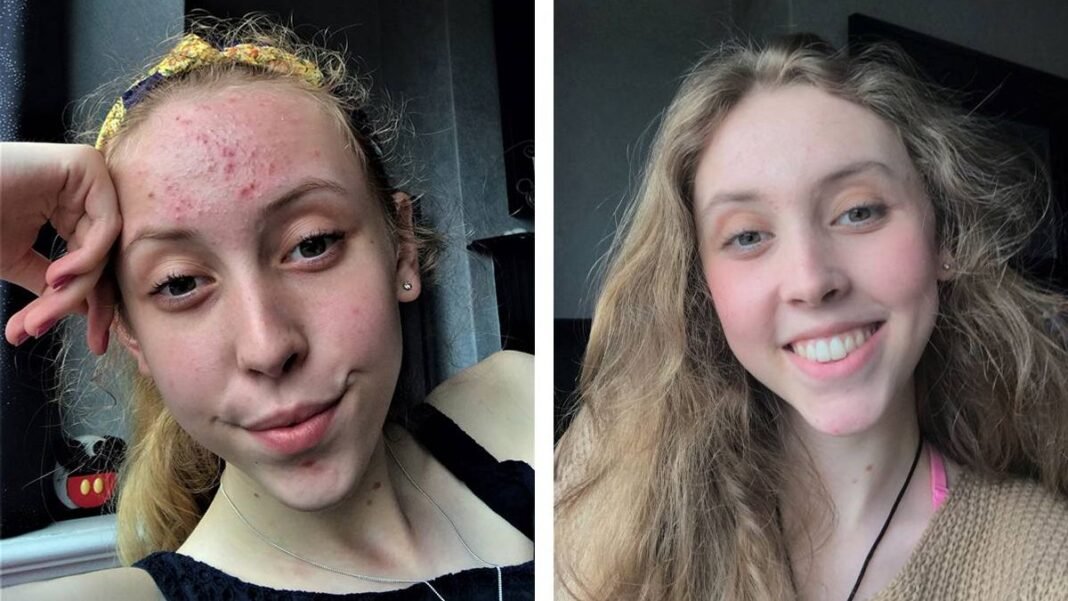 “£16 Amazon Product Clears Acne, Boosts Confidence”
